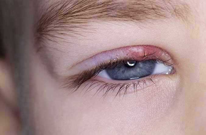 نکته بهداشتی، پیشگیری از گل مژه